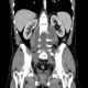 Neurofibromatosis, type I, von Recklinghausen disease, neurofibroma: CT - Computed tomography